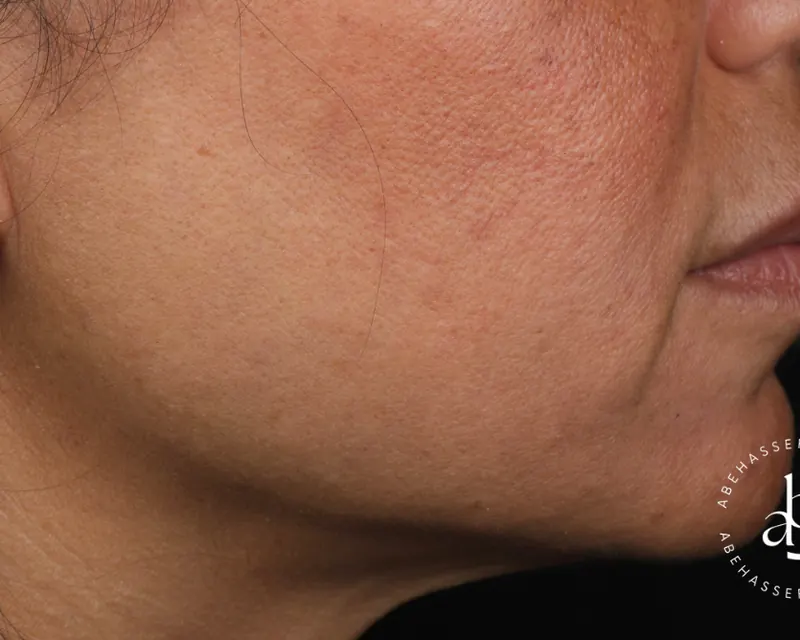 Cas clinique 002 — Injection d'acide hyaluronique péri-buccale au niveau de l'angle mandibulaire au cabinet du Dr Bruno Abehassera à Levallois-Perret, vue après