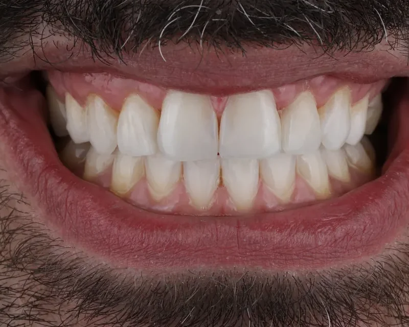 Cas clinique 005 — Composite stratifié sur dents antérieures au cabinet du Dr Bruno Abehassera à Levallois-Perret, vue après traitement