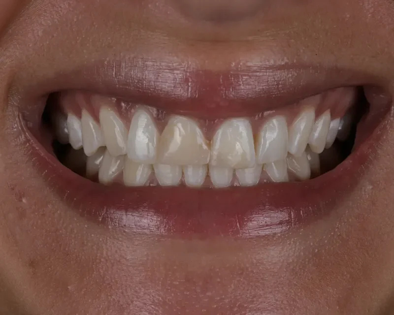 Cas clinique 001 — Composite stratifié sur dents antérieures au cabinet du Dr Bruno Abehassera à Levallois-Perret, vue avant traitement