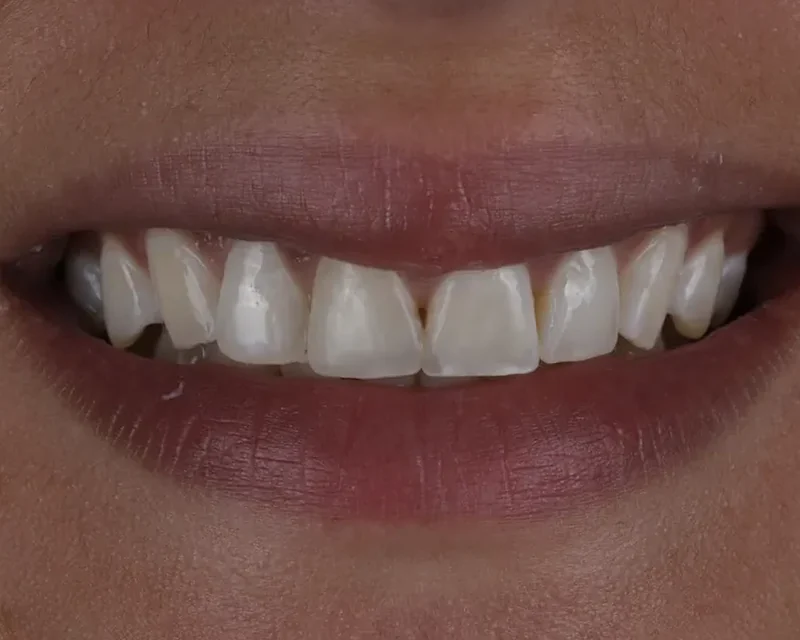 Cas clinique 001 — Composite stratifié sur dents antérieures au cabinet du Dr Bruno Abehassera à Levallois-Perret, vue après traitement