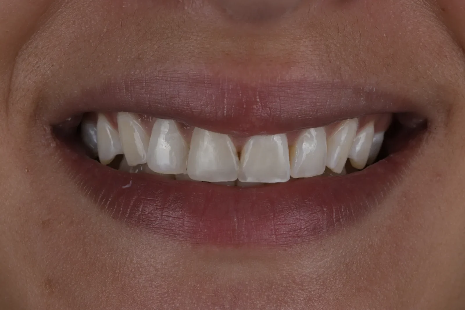 Cas clinique 001 — Composite stratifié sur dents antérieures au cabinet du Dr Bruno Abehassera à Levallois-Perret, vue après traitement