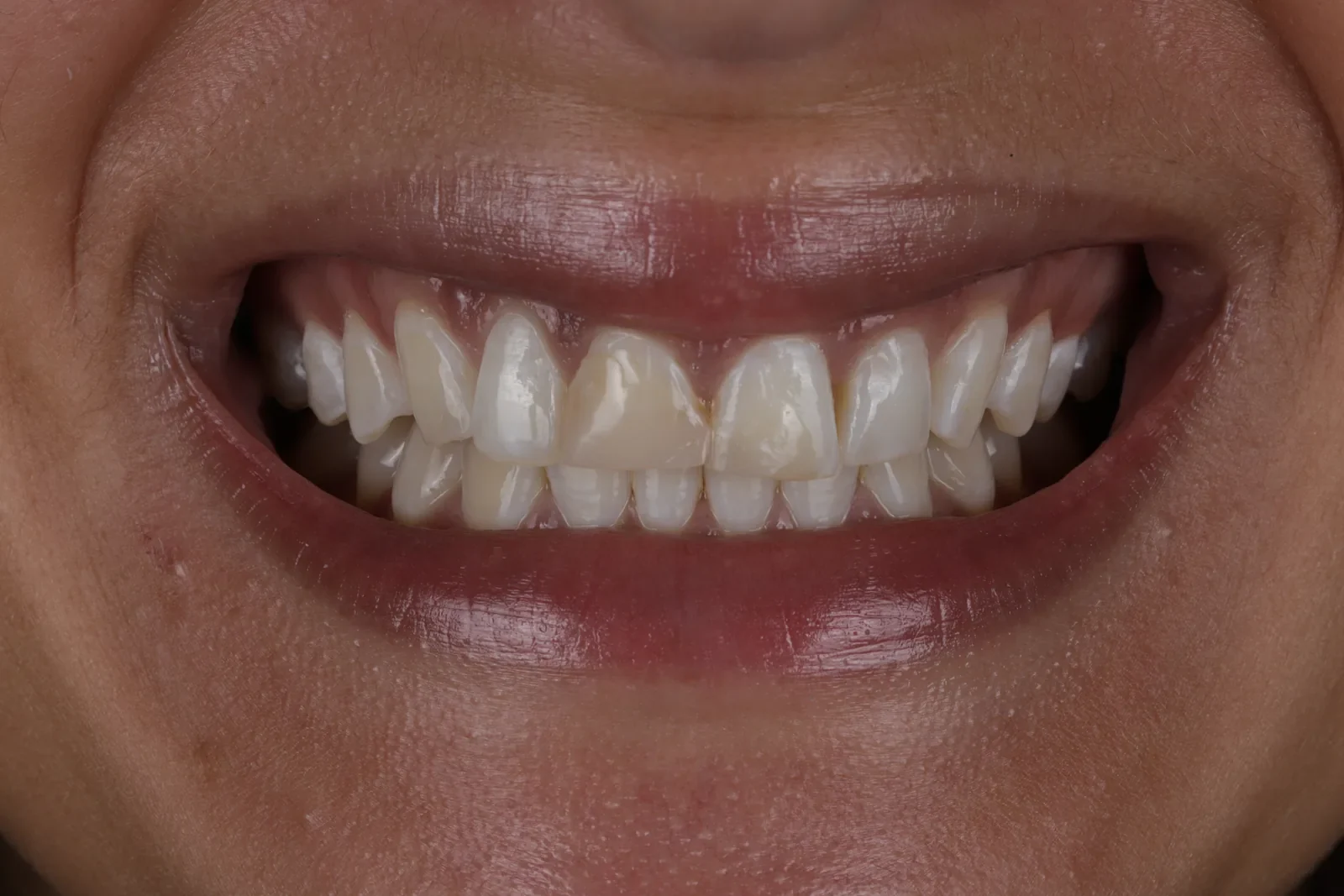 Cas clinique 001 — Composite stratifié sur dents antérieures au cabinet du Dr Bruno Abehassera à Levallois-Perret, vue avant traitement
