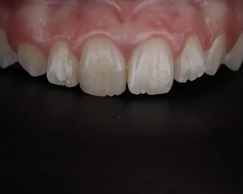Cas clinique 002 — Composite stratifié sur dents antérieures au cabinet du Dr Bruno Abehassera à Levallois-Perret, vue avant traitement