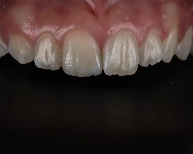 Cas clinique 002 — Composite stratifié sur dents antérieures au cabinet du Dr Bruno Abehassera à Levallois-Perret, vue après traitement