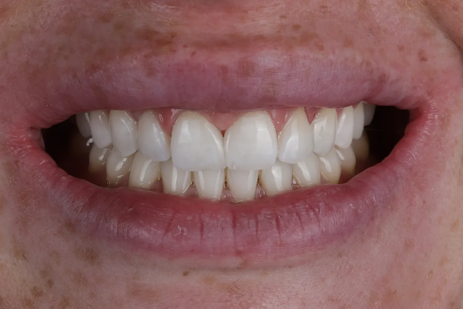 Cas clinique 003 — Composite stratifié pour fermeture de diastèmes sur dents antérieures au cabinet du Dr Bruno Abehassera à Levallois-Perret, vue après traitement