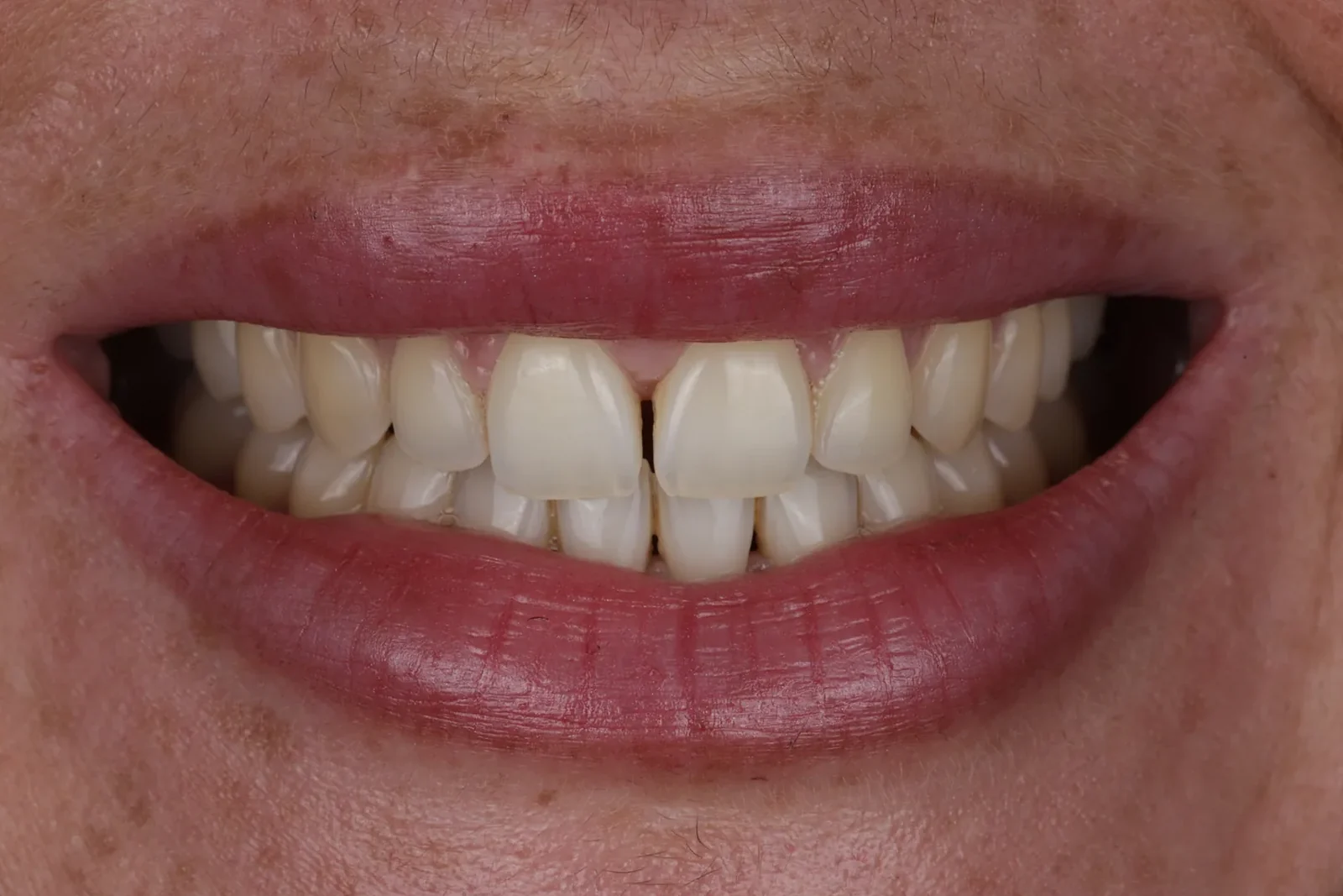 Cas clinique 003 — Composite stratifié pour fermeture de diastèmes sur dents antérieures au cabinet du Dr Bruno Abehassera à Levallois-Perret, vue avant traitement
