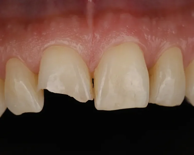 Cas clinique 004 — Composite stratifié sur fracture coronaire sur dents antérieures au cabinet du Dr Bruno Abehassera à Levallois-Perret, vue avant traitement