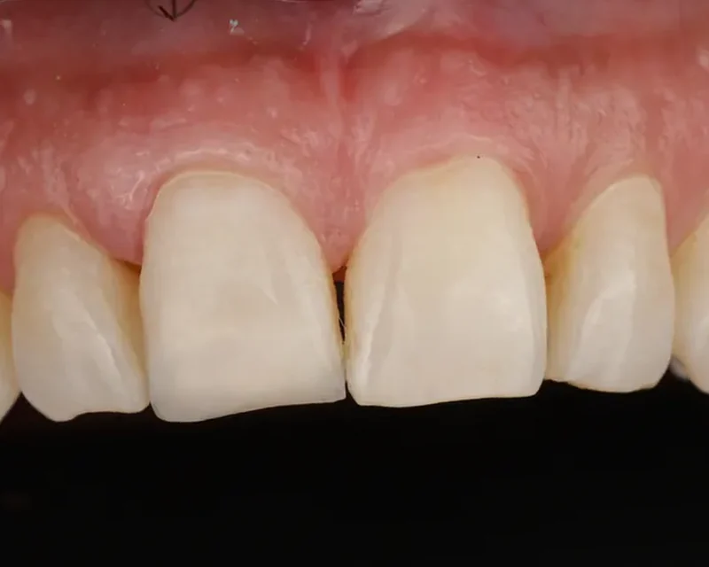 Cas clinique 004 — Composite stratifié sur fracture coronaire sur dents antérieures au cabinet du Dr Bruno Abehassera à Levallois-Perret, vue après traitement