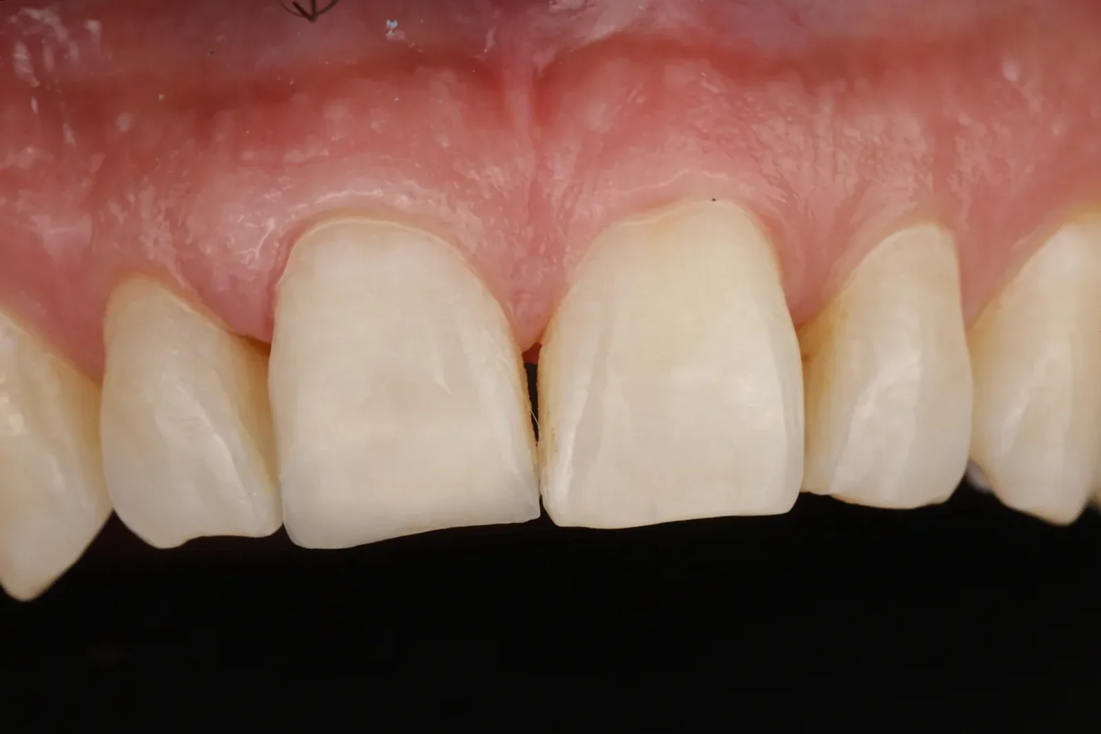 Cas clinique 004 — Composite stratifié sur fracture coronaire sur dents antérieures au cabinet du Dr Bruno Abehassera à Levallois-Perret, vue après traitement