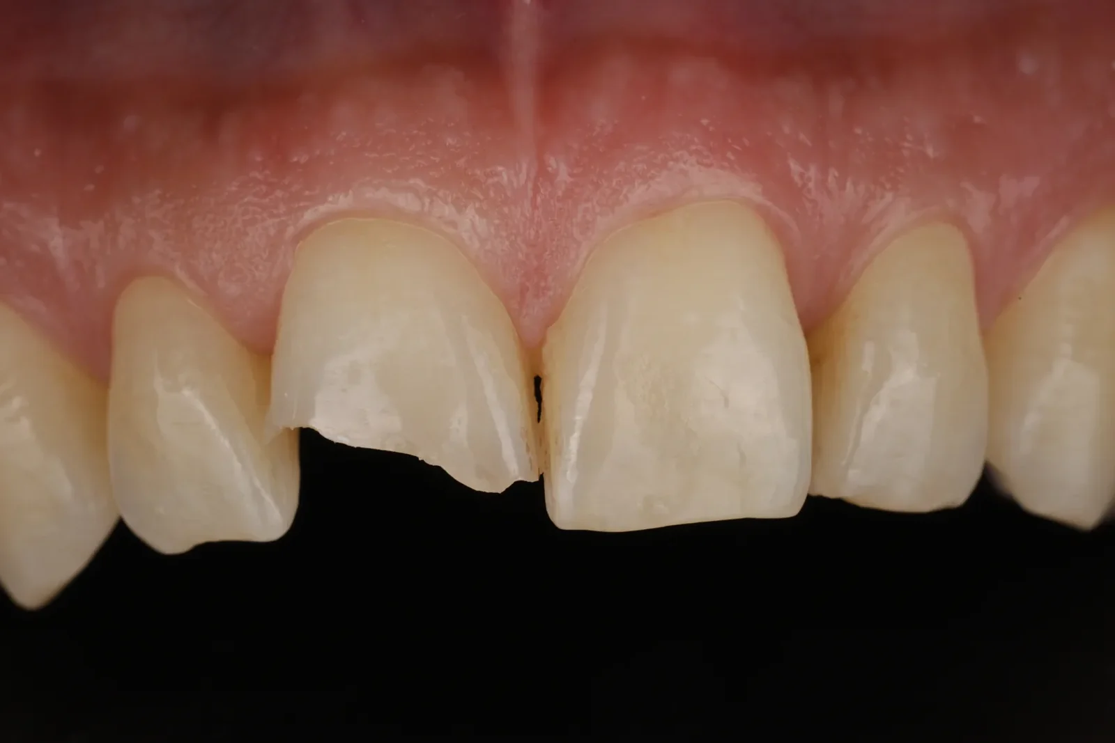Cas clinique 004 — Composite stratifié sur fracture coronaire sur dents antérieures au cabinet du Dr Bruno Abehassera à Levallois-Perret, vue avant traitement
