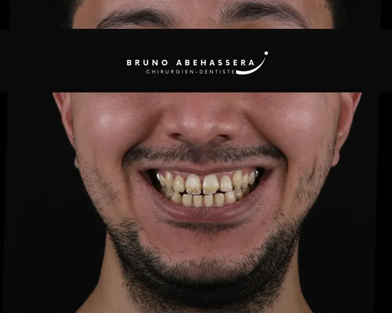 Cas clinique 003 — Facettes céramiques pelliculaires au cabinet du Dr Bruno Abehassera à Levallois-Perret, vue de face avant traitement