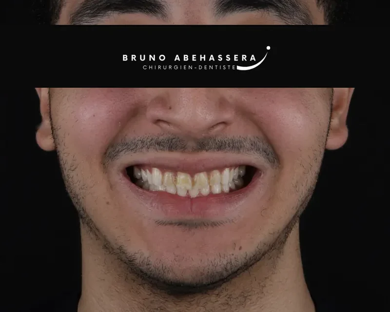 Cas clinique 005 — Facettes céramiques pelliculaires au cabinet du Dr Bruno Abehassera à Levallois-Perret, vue de face avant traitement