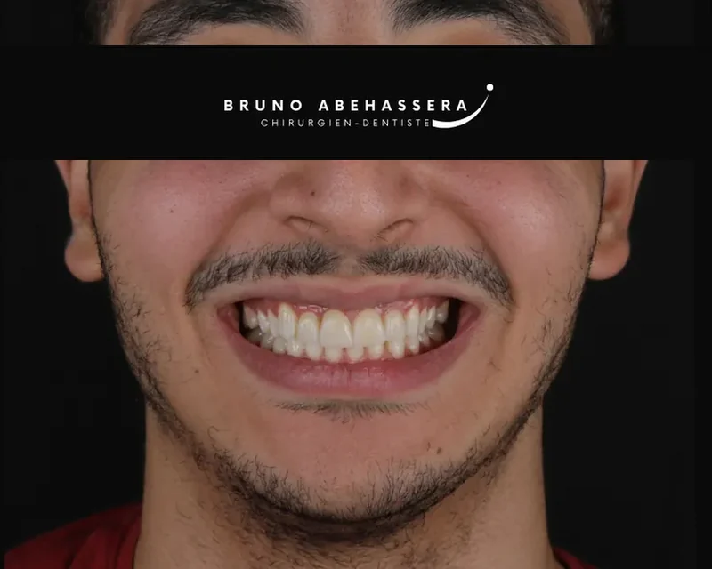 Cas clinique 005 — Facettes céramiques pelliculaires au cabinet du Dr Bruno Abehassera à Levallois-Perret, vue de face après traitement