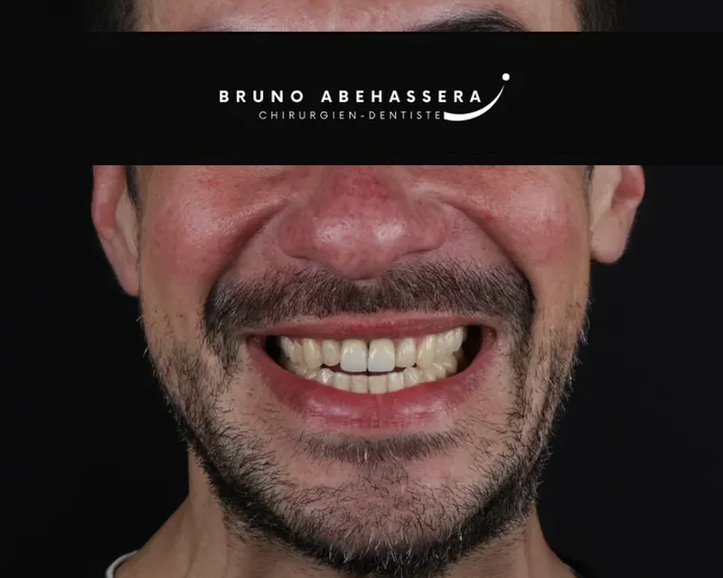 Cas clinique 006 — Facettes céramiques pelliculaires au cabinet du Dr Bruno Abehassera à Levallois-Perret, vue de face avant traitement