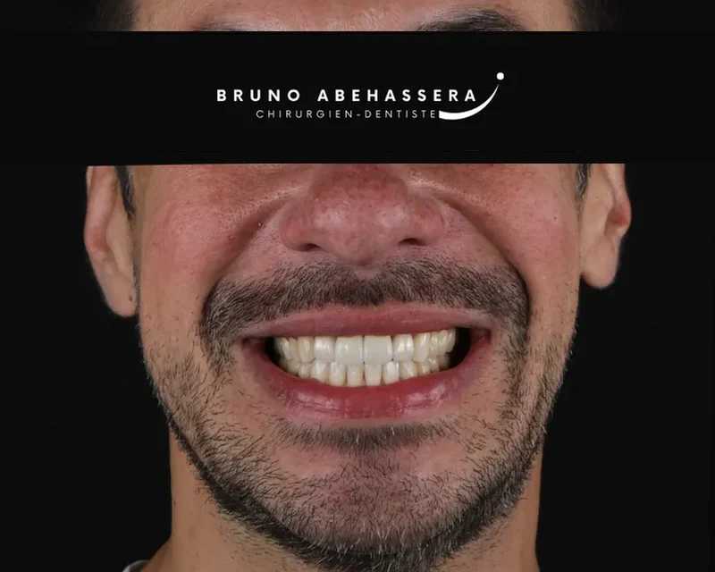 Cas clinique 006 — Facettes céramiques pelliculaires au cabinet du Dr Bruno Abehassera à Levallois-Perret, vue de face après traitement
