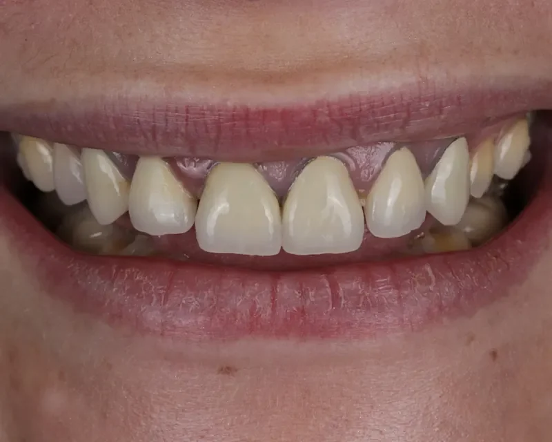 Cas clinique 006 — Réhabilitation complexe avec facettes et couronnes en céramiques au cabinet du Dr Bruno Abehassera à Levallois-Perret, vue avant traitement
