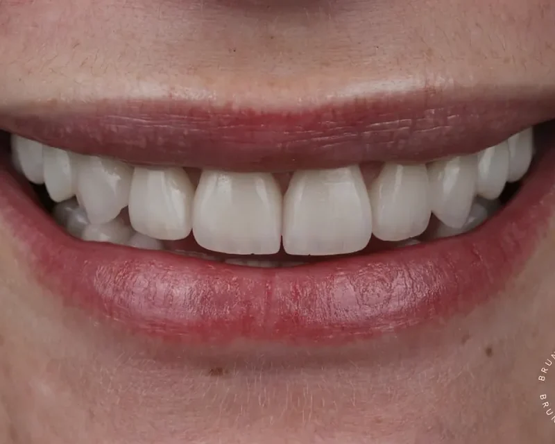 Cas clinique 006 — Réhabilitation complexe avec facettes et couronnes en céramiques au cabinet du Dr Bruno Abehassera à Levallois-Perret, vue après traitement