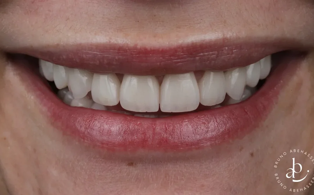 Cas clinique 006 — Réhabilitation complexe avec facettes et couronnes en céramiques au cabinet du Dr Bruno Abehassera à Levallois-Perret, vue après traitement
