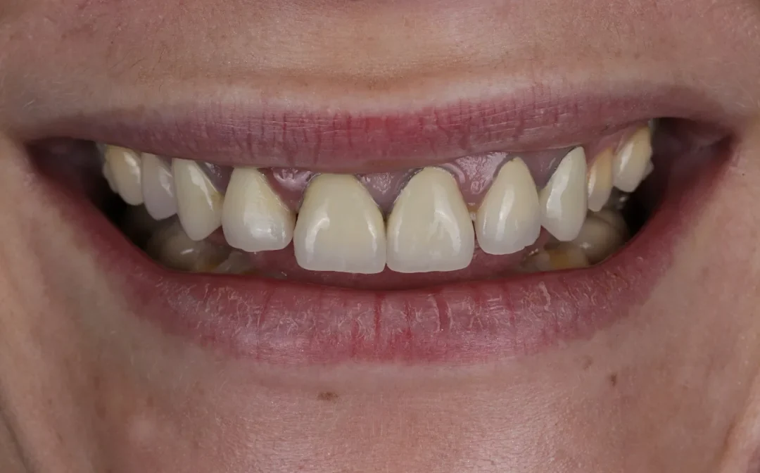 Cas clinique 006 — Réhabilitation complexe avec facettes et couronnes en céramiques au cabinet du Dr Bruno Abehassera à Levallois-Perret, vue avant traitement