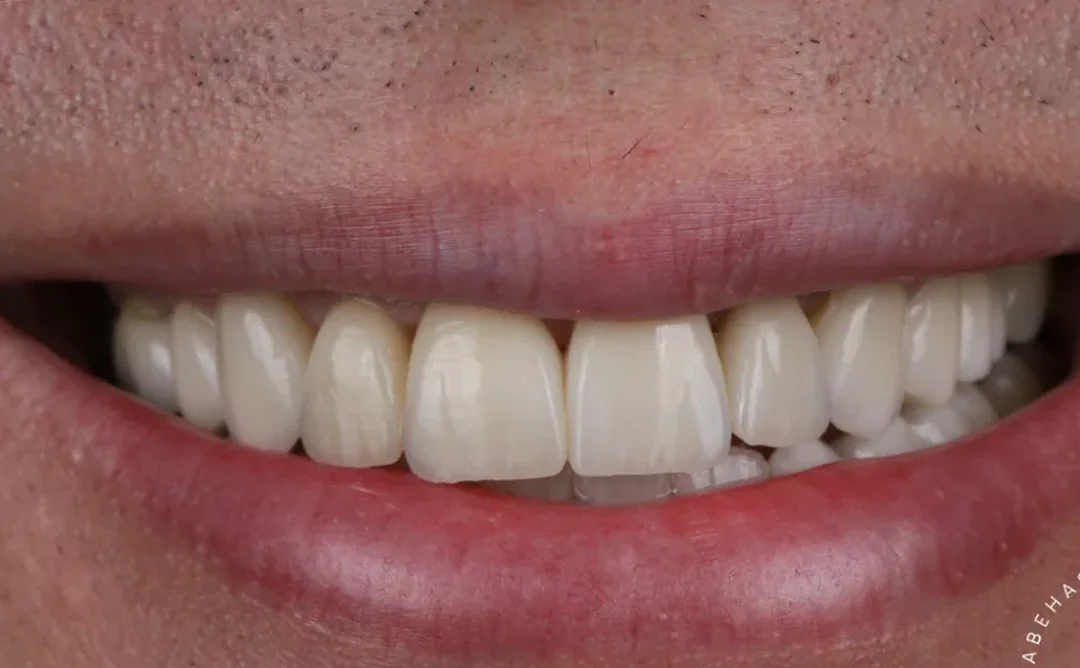 Cas clinique 001 — Réhabilitation complexe avec facettes et onlays céramiques au cabinet du Dr Bruno Abehassera à Levallois-Perret, vue après traitement