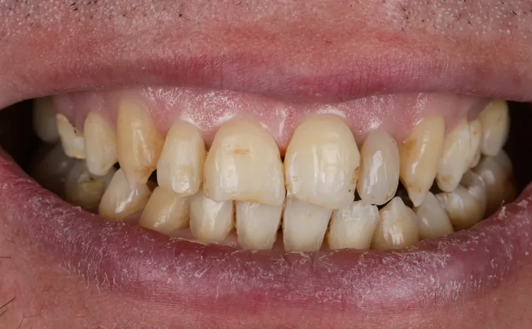 Cas clinique 001 — Réhabilitation complexe avec facettes et onlays céramiques au cabinet du Dr Bruno Abehassera à Levallois-Perret, vue avant traitement