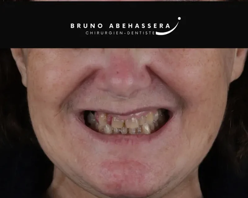 Cas clinique 002 — Réhabilitation complexe avec facettes et onlays céramiques au cabinet du Dr Bruno Abehassera à Levallois-Perret, vue avant traitement