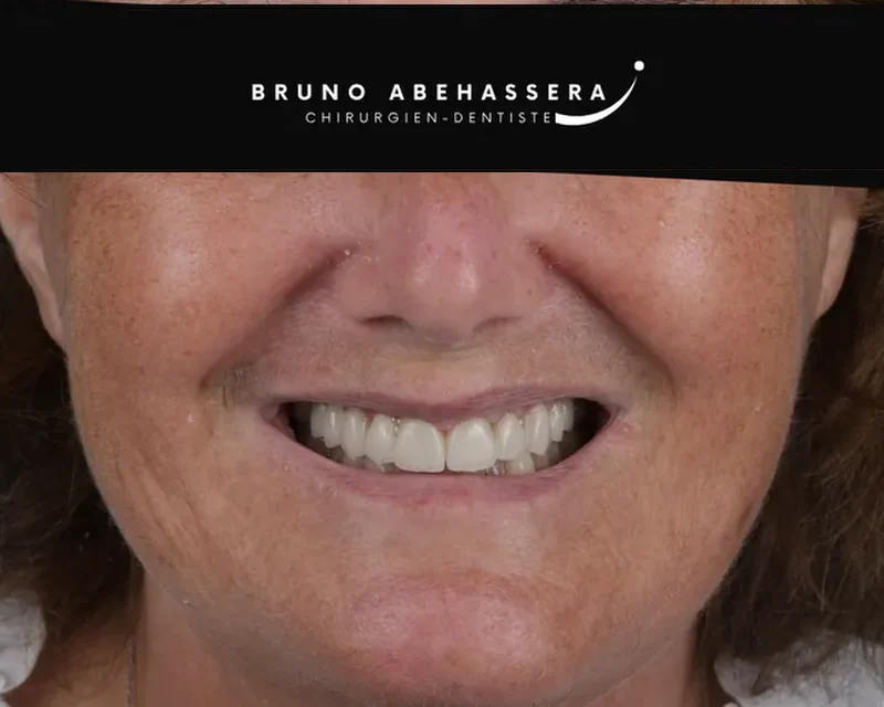 Cas clinique 002 — Réhabilitation complexe avec facettes et onlays céramiques au cabinet du Dr Bruno Abehassera à Levallois-Perret, vue après traitement