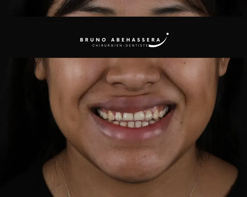 Cas clinique 003 — Réhabilitation complexe avec facettes et onlays céramiques au cabinet du Dr Bruno Abehassera à Levallois-Perret, vue avant traitement