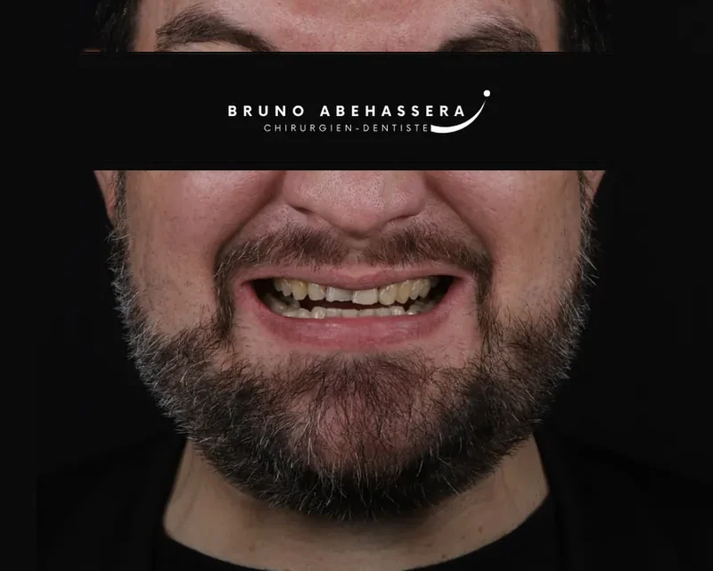 Cas clinique 004 — Réhabilitation complexe avec facettes et onlays céramiques au cabinet du Dr Bruno Abehassera à Levallois-Perret, vue avant traitement