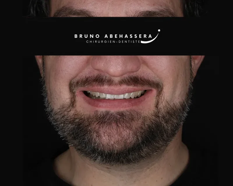 Cas clinique 004 — Réhabilitation complexe avec facettes et onlays céramiques au cabinet du Dr Bruno Abehassera à Levallois-Perret, vue après traitement