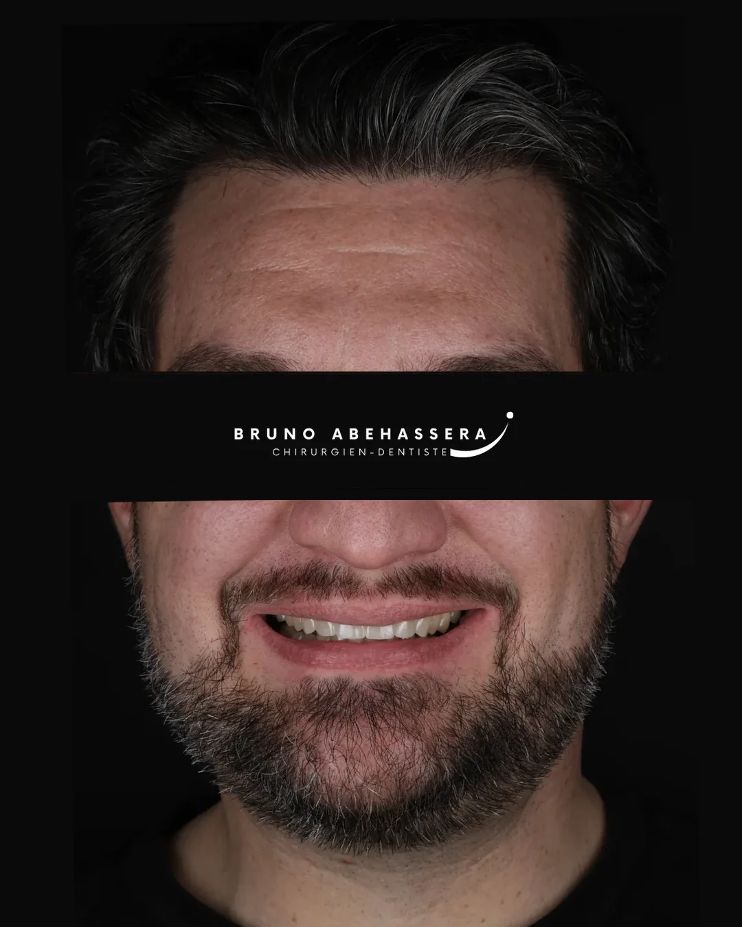 Cas clinique 004 — Réhabilitation complexe avec facettes et onlays céramiques au cabinet du Dr Bruno Abehassera à Levallois-Perret, vue après traitement