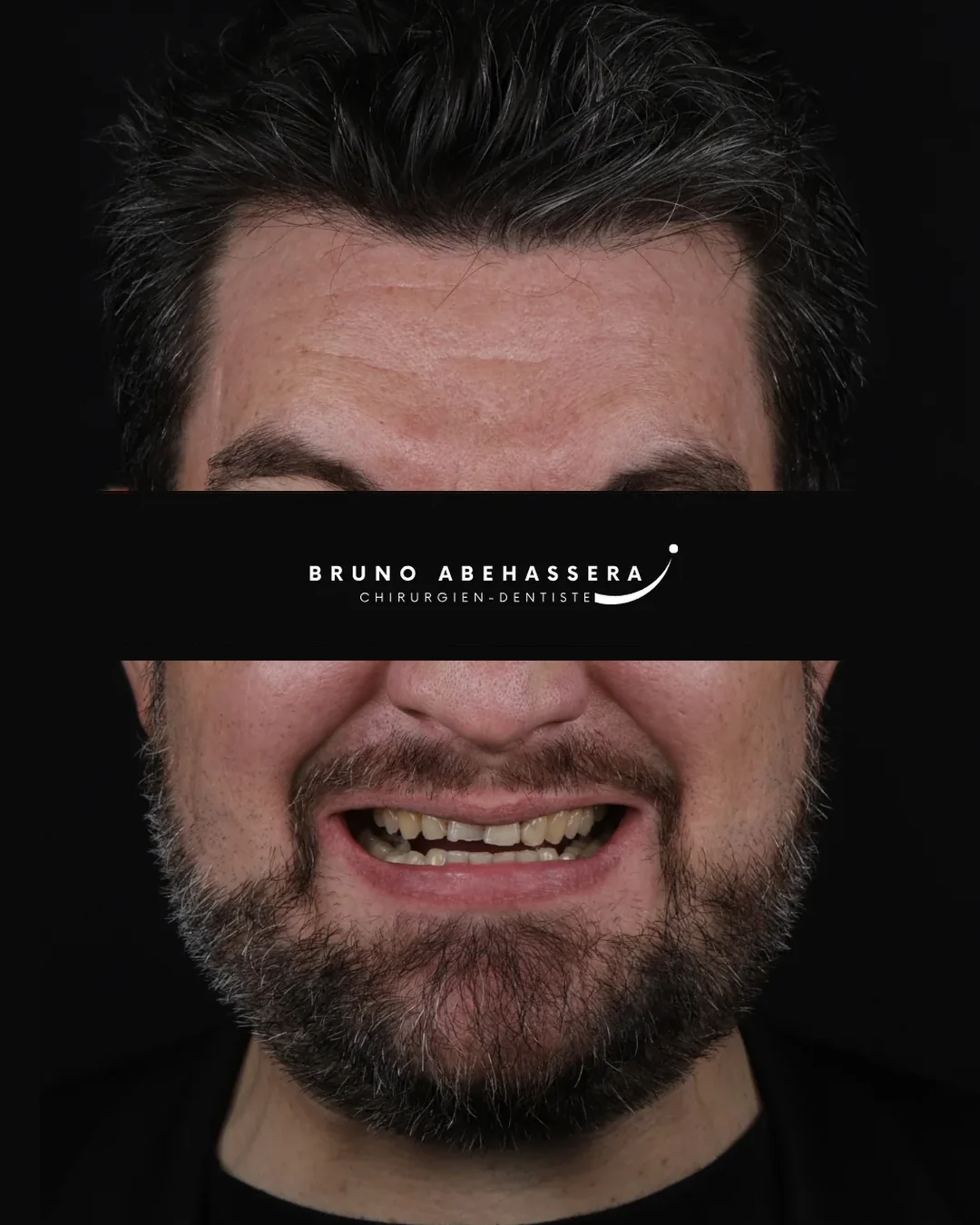 Cas clinique 004 — Réhabilitation complexe avec facettes et onlays céramiques au cabinet du Dr Bruno Abehassera à Levallois-Perret, vue avant traitement