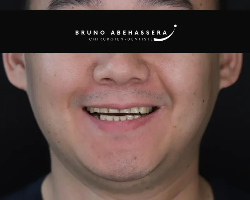 Cas clinique 005 — Réhabilitation complexe avec facettes et onlays céramiques au cabinet du Dr Bruno Abehassera à Levallois-Perret, vue avant traitement