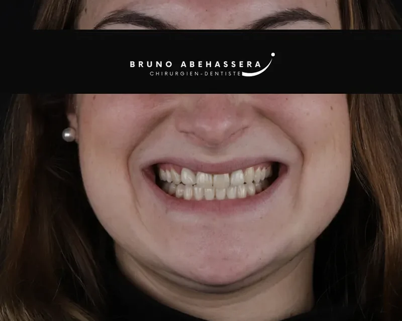 Cas clinique 002 — Facettes céramiques pelliculaires sur cas d'agénésie dentaire au cabinet du Dr Bruno Abehassera à Levallois-Perret, vue de face avant traitement