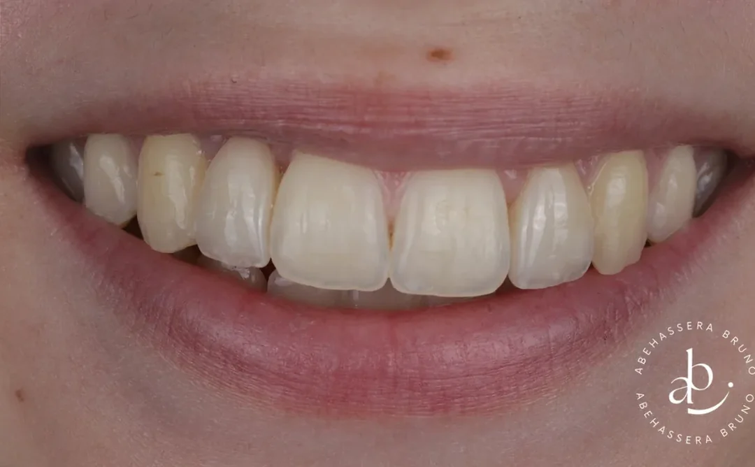 Cas clinique 008 — Facettes céramiques pelliculaires et bridge cantilever au cabinet du Dr Bruno Abehassera à Levallois-Perret, vue de face après traitement