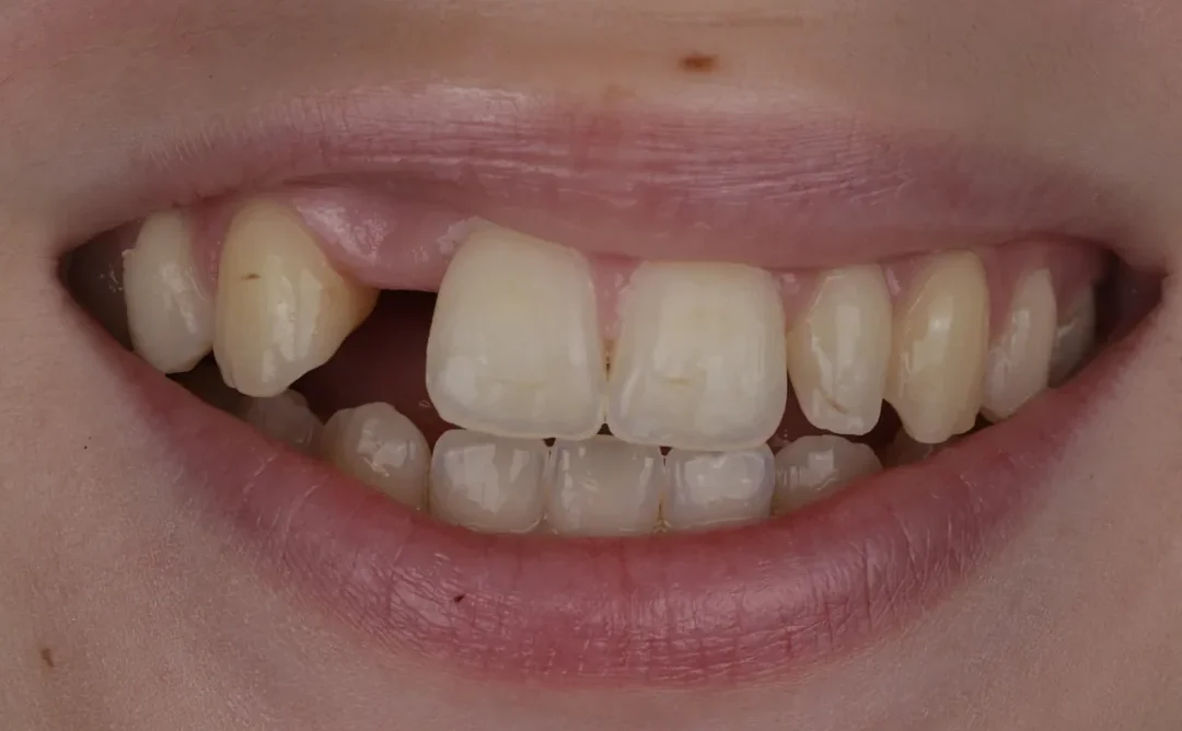 Cas clinique 008 — Facettes céramiques pelliculaires et bridge cantilever au cabinet du Dr Bruno Abehassera à Levallois-Perret, vue de face avant traitement