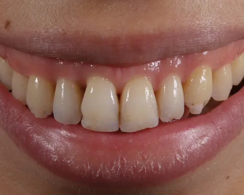 Cas clinique 004 — Facettes céramiques pelliculaires pour correction triangles noirs au cabinet du Dr Bruno Abehassera à Levallois-Perret, vue de face avant traitement
