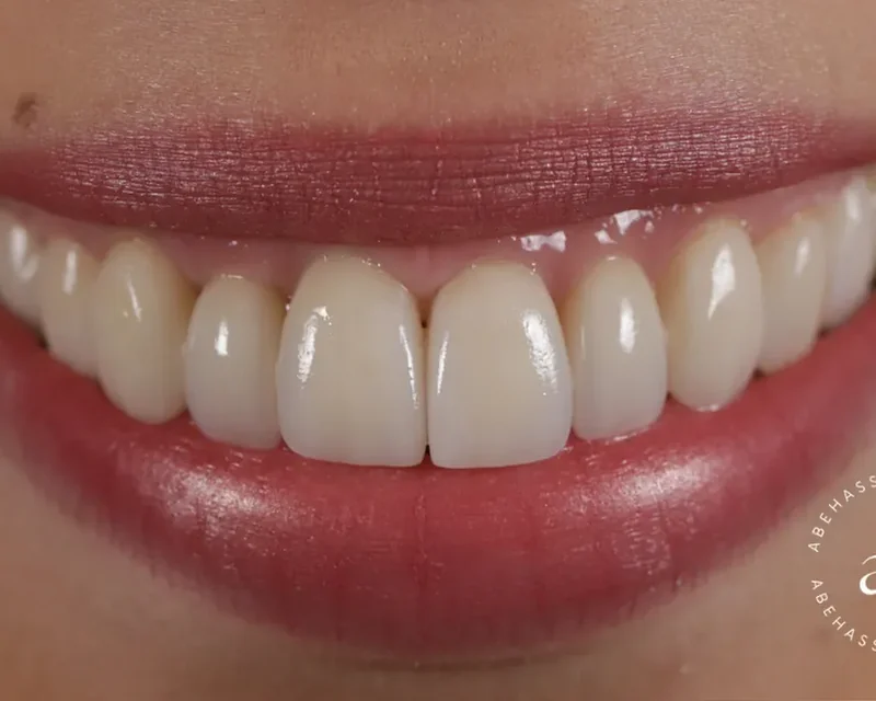 Cas clinique 004 — Facettes céramiques pelliculaires pour correction triangles noirs au cabinet du Dr Bruno Abehassera à Levallois-Perret, vue de face après traitement