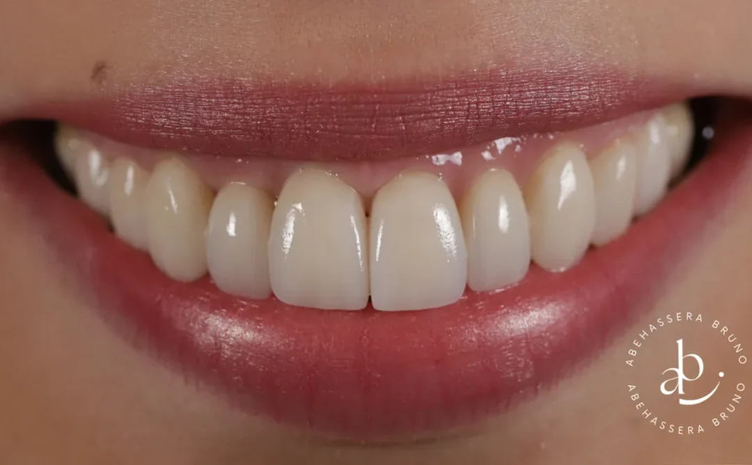Cas clinique 004 — Facettes céramiques pelliculaires pour correction triangles noirs au cabinet du Dr Bruno Abehassera à Levallois-Perret, vue de face après traitement