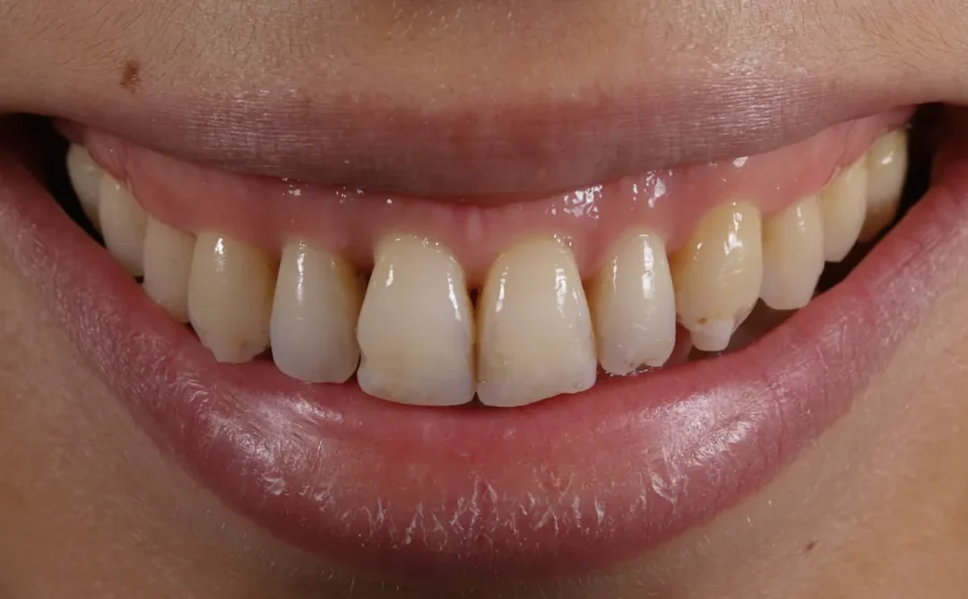 Cas clinique 004 — Facettes céramiques pelliculaires pour correction triangles noirs au cabinet du Dr Bruno Abehassera à Levallois-Perret, vue de face avant traitement