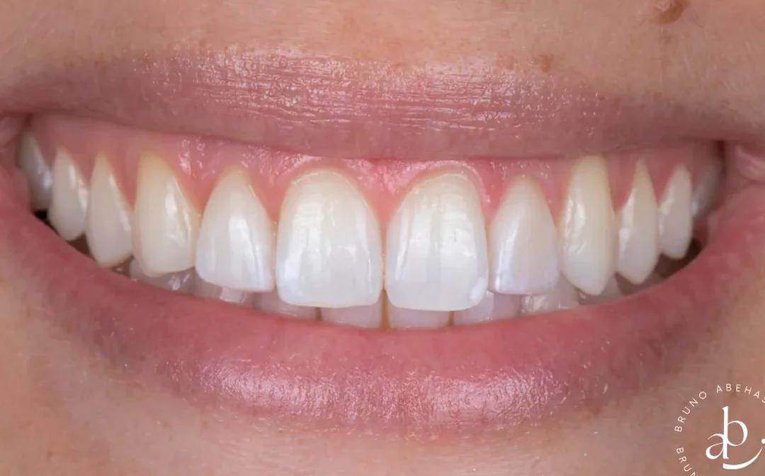 Cas clinique 007 — Facettes céramiques pelliculaires sur dentz riziformes au cabinet du Dr Bruno Abehassera à Levallois-Perret, vue de face après traitement