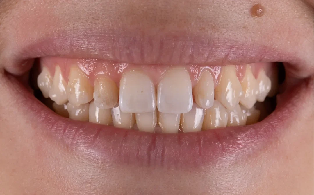 Cas clinique 007 — Facettes céramiques pelliculaires sur dentz riziformes au cabinet du Dr Bruno Abehassera à Levallois-Perret, vue de face avant traitement