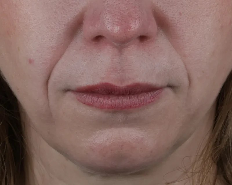 Cas clinique 001 — Injection d'acide hyaluronique péri-buccale au niveau des sillons naso-géniens au cabinet du Dr Bruno Abehassera à Levallois-Perret, vue avant