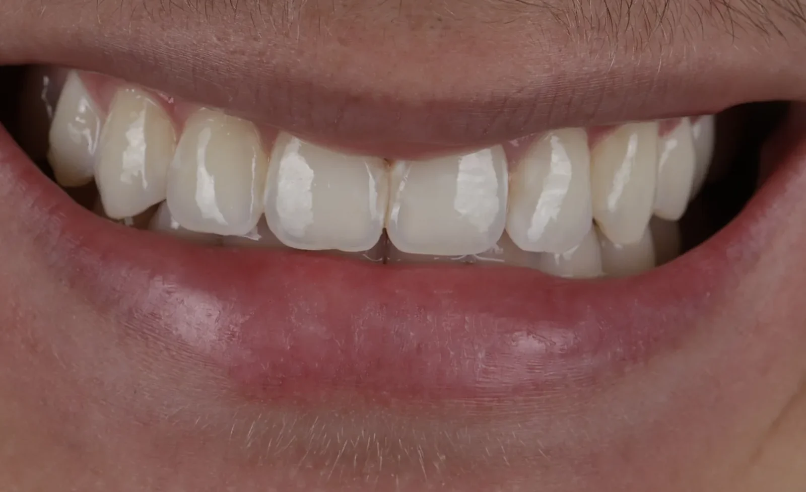 Cas clinique 003 — Masquage de taches blanches post-orthodontiques (white spots) par technique ICON au cabinet du Dr Bruno Abehassera à Levallois-Perret, vue après traitement