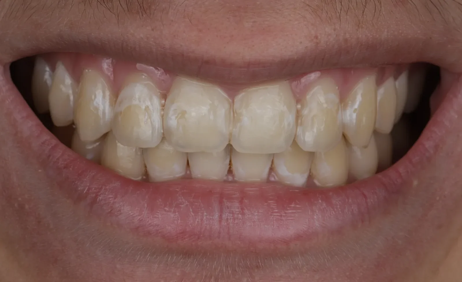 Cas clinique 003 — Masquage de taches blanches post-orthodontiques (white spots) par technique ICON au cabinet du Dr Bruno Abehassera à Levallois-Perret, vue avant traitement