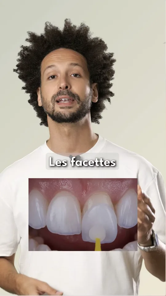 Facettes dentaires — FAQ Dr Bruno Abehassera