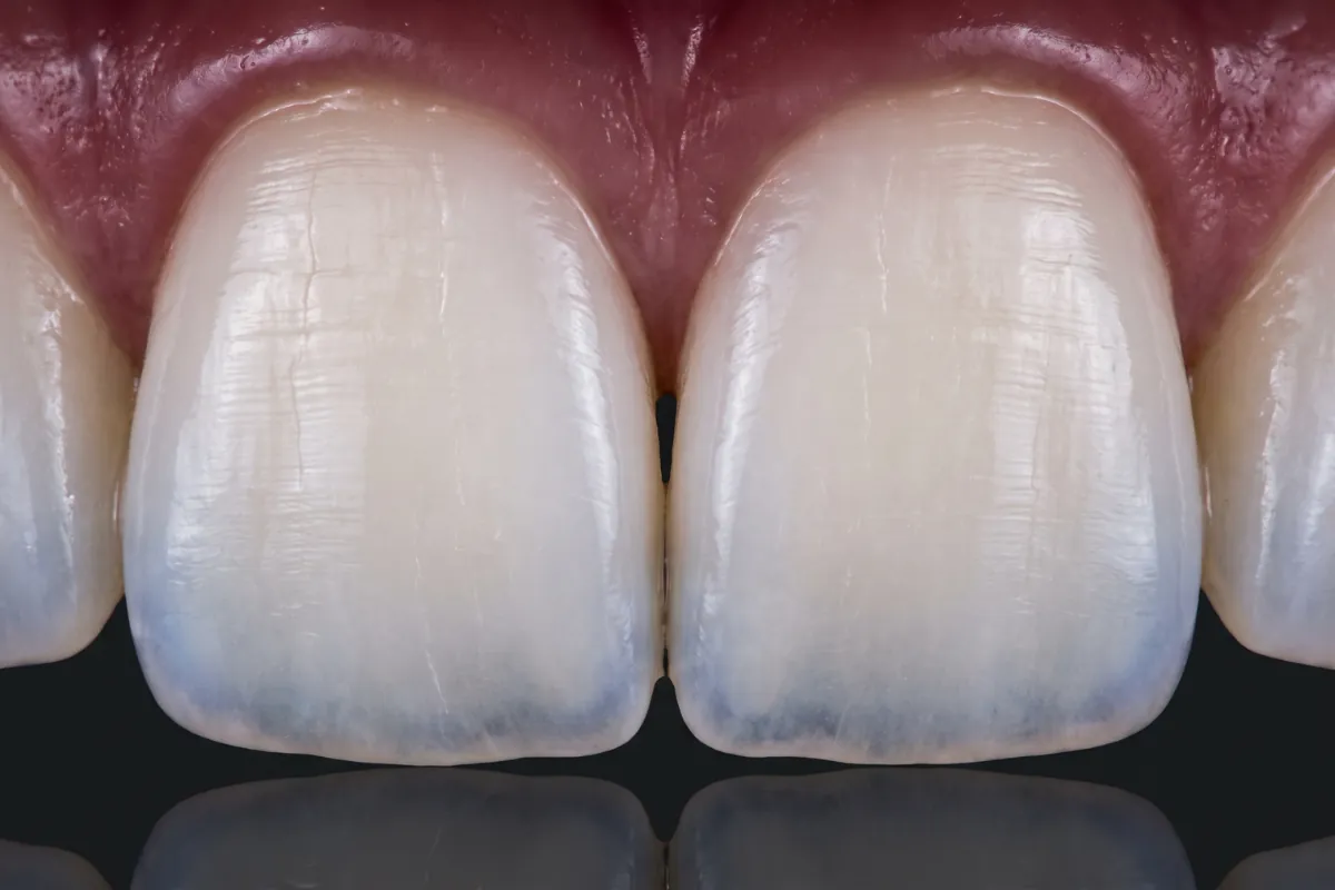 Macro d'émail naturel sur deux incisives, translucidité du bord libre et fines lignes de surface, image d'illustration