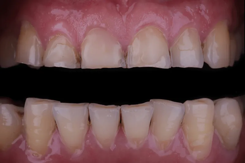 Dents abîmées par le bruxisme : causes, conséquences et solutions à Levallois-Perret