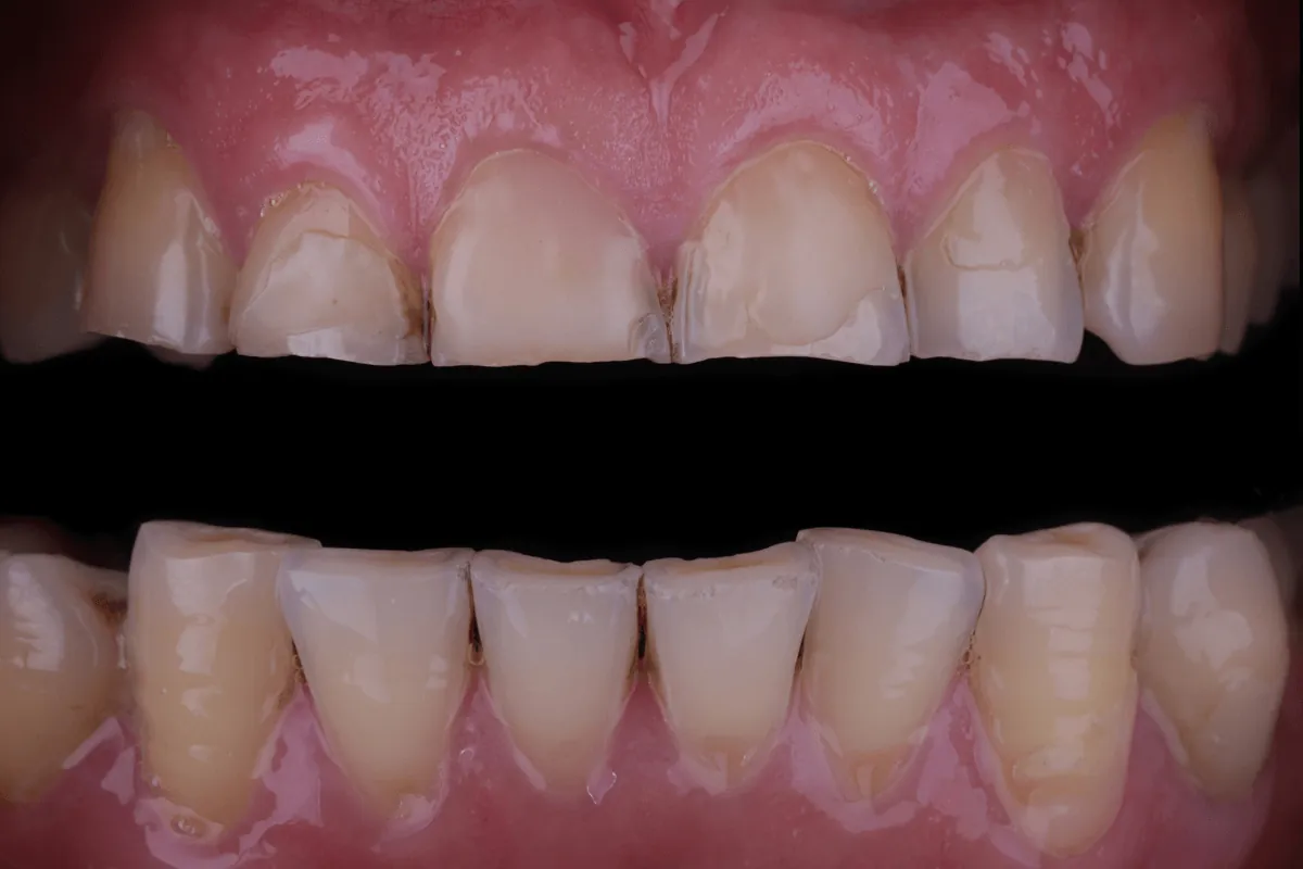 Dents abîmées par le bruxisme : causes, conséquences et solutions à Levallois-Perret