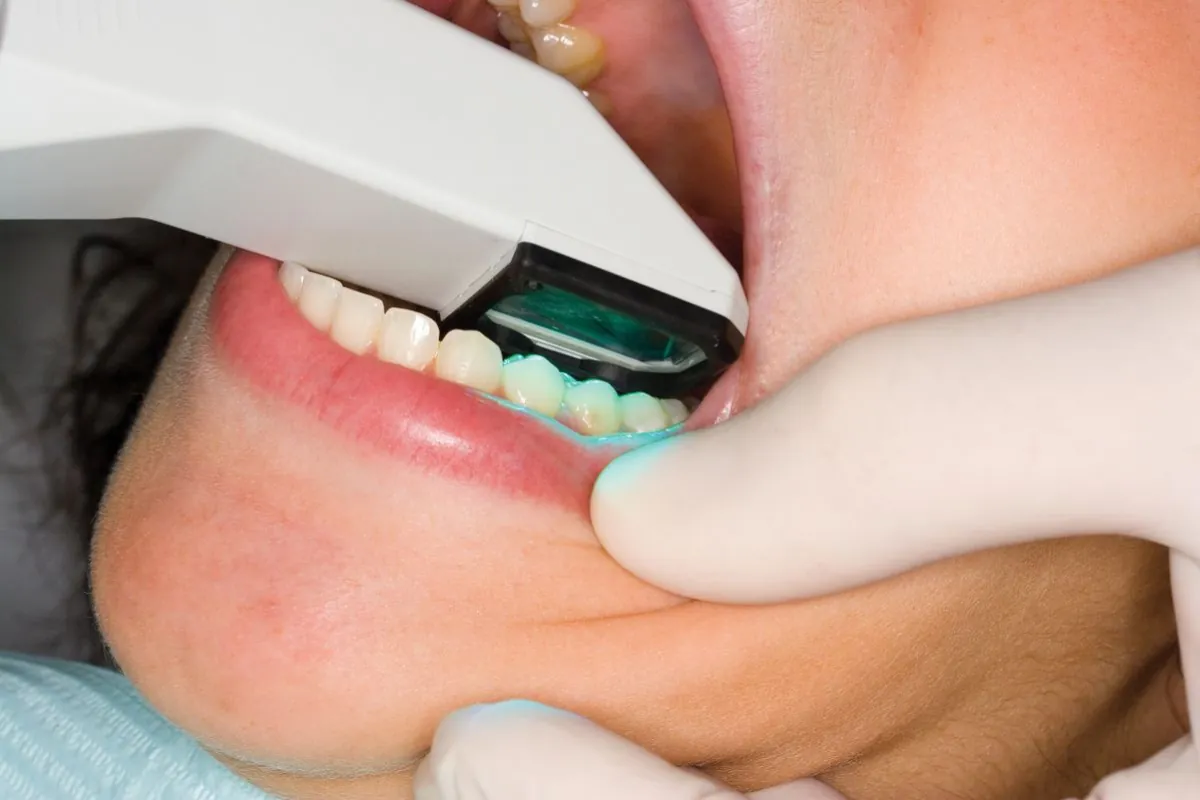 Scanner intra-oral en cours d'utilisation pour diagnostic des usures dentaires — cabinet du Dr Bruno Abehassera à Levallois-Perret